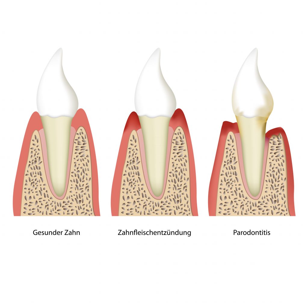 Stadien der Parodontitis