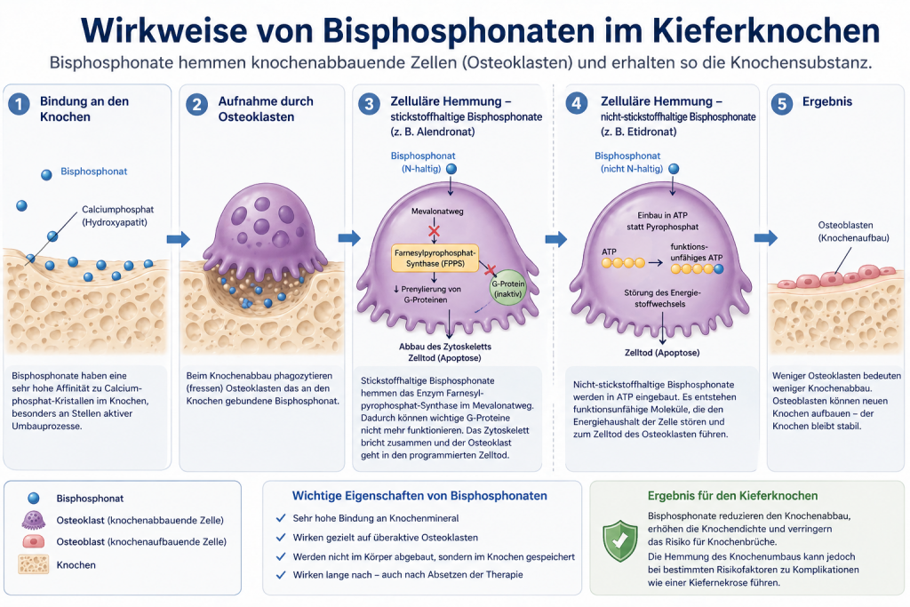 Darstellung der Wirkung von Bisphosphonaten auf den Kieferknochen